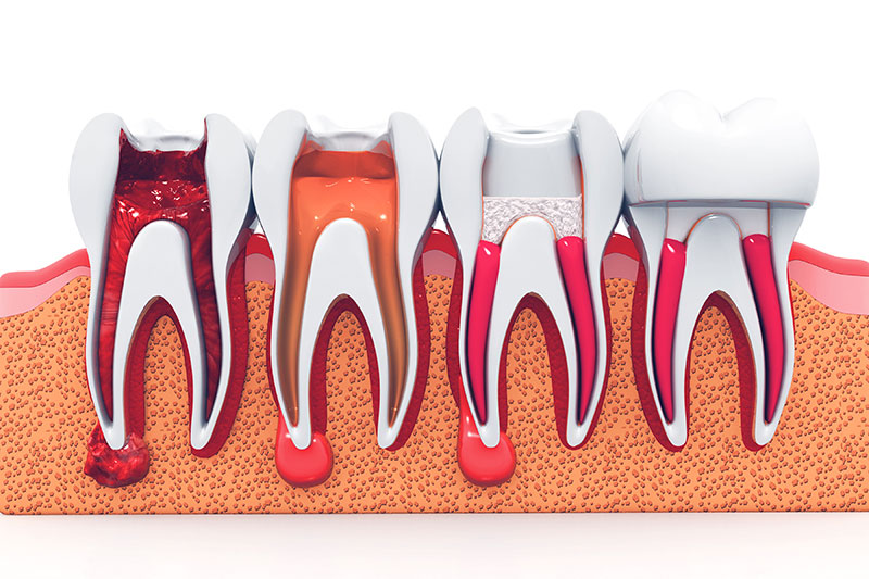 Services Advanced Endodontics