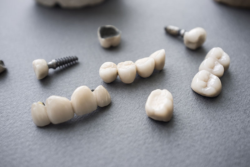 Services Full Mouth Reconstruction