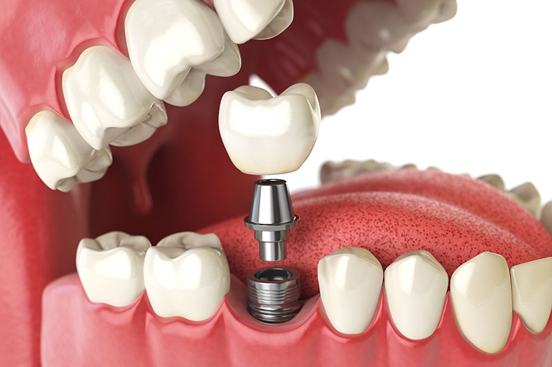 Services Implant Restoration