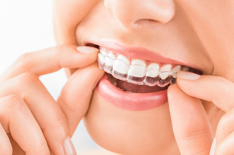 Services Invisalign (Clear Aligners)