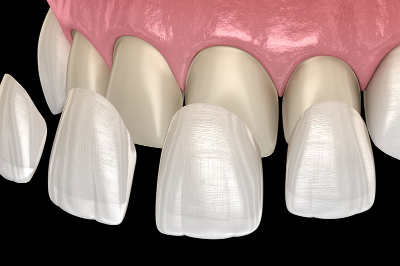Services Veneers